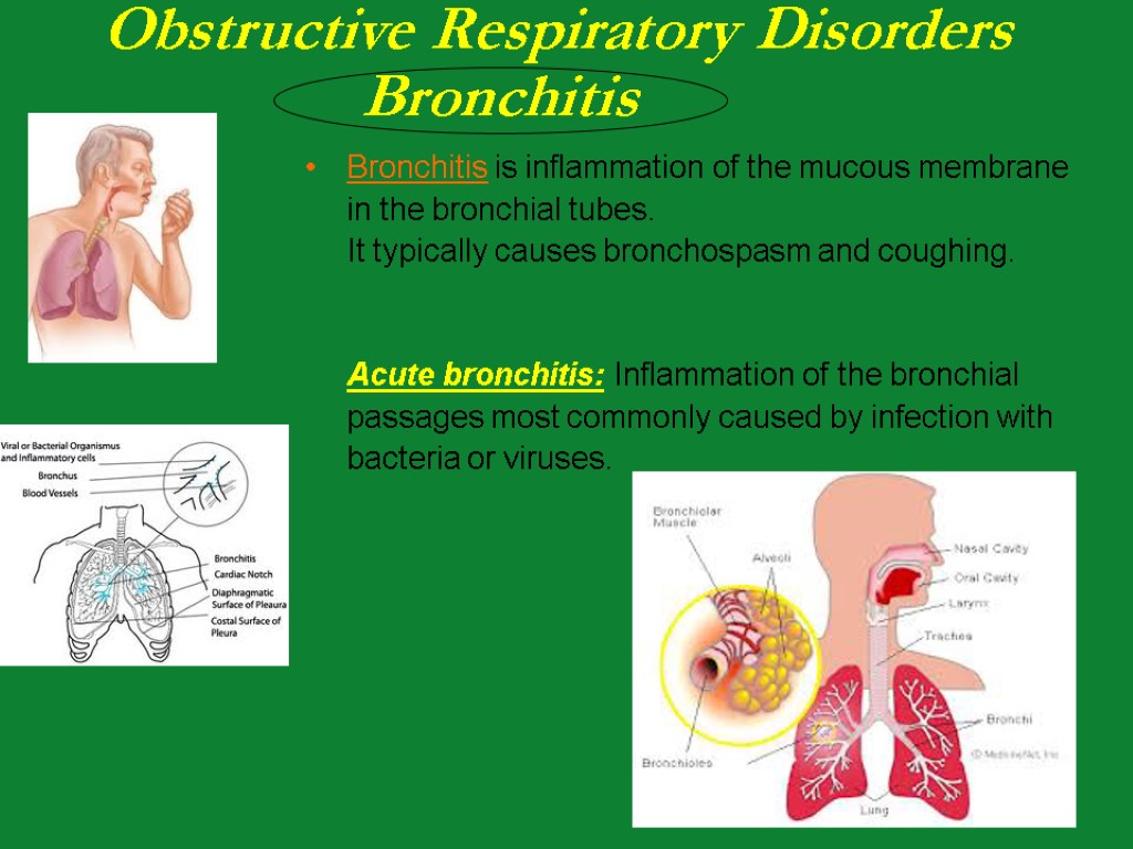 Bronchitis is inflammation of the mucous membrane in the bronchial tubes. It typically causes